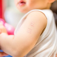 BCGワクチンの接種痕（赤ちゃんの腕）の写真