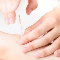 腕に鍼を施術する医療行為と複数の経穴治療の写真