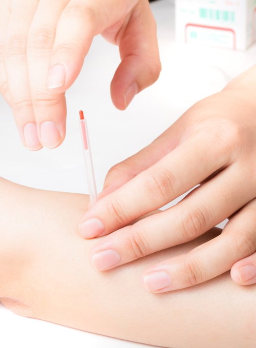 腕に鍼を施術する医療行為と複数の経穴治療