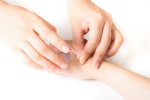 手のツボに鍼をさす鍼灸師の丁寧な施術の様子