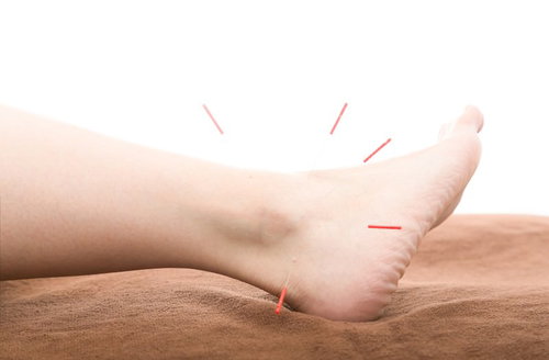 足首を中心とした鍼治療でリラクゼーション