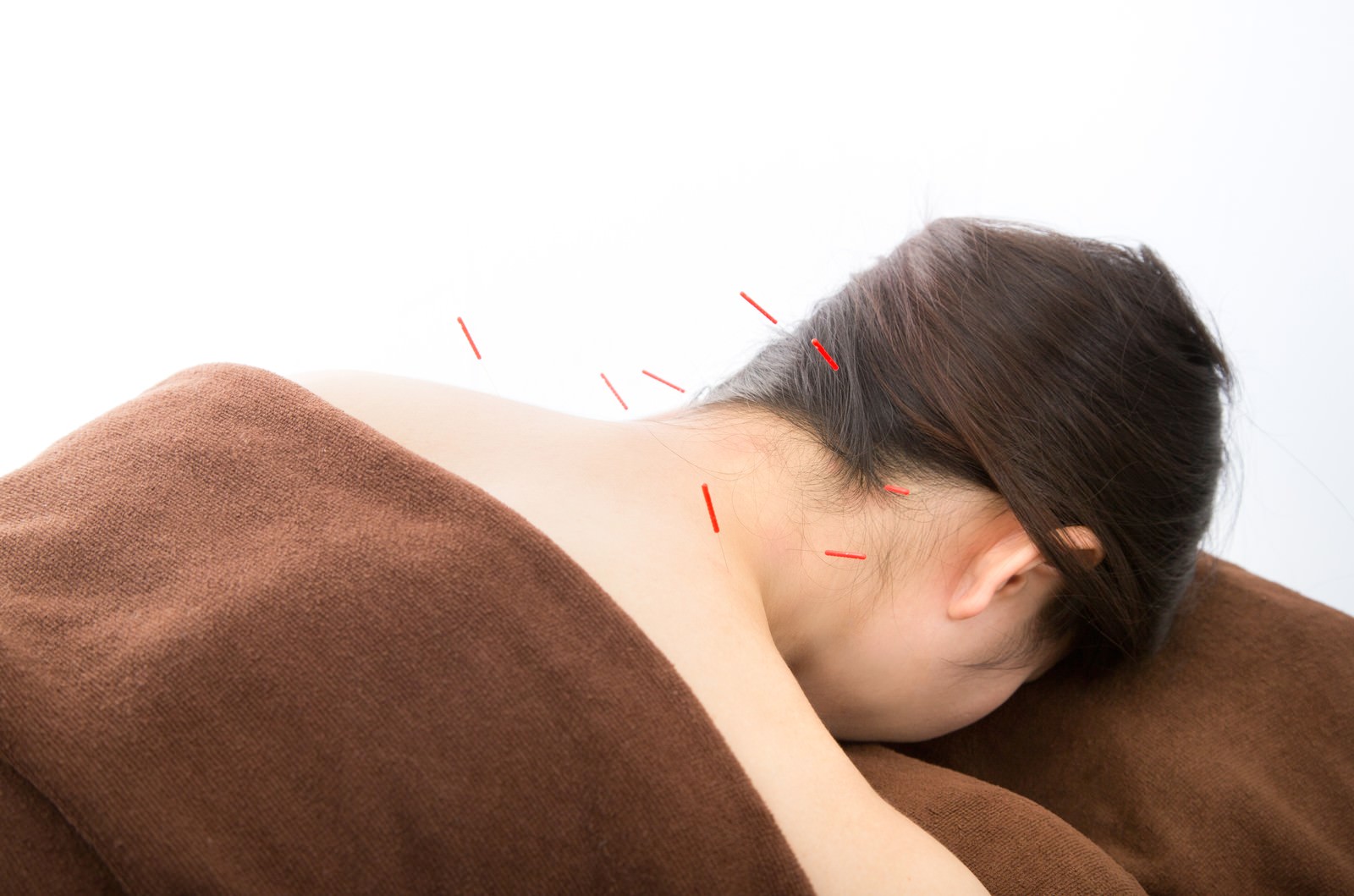首と肩に鍼治療を受ける女性が茶色いタオルをかぶってうつ伏せで横たわっている