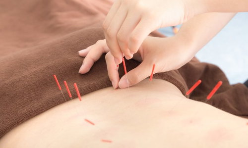 背中に鍼治療を施すリラクゼーションサロンでの施術風景