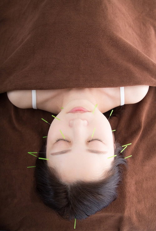 美容鍼でリラクゼーションを受ける女性の背中