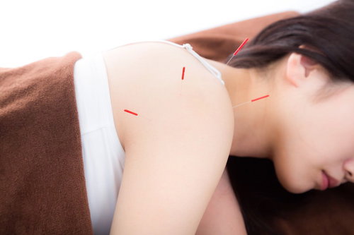 肩こり改善のための鍼治療をする女性のリラクゼーション