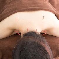 鍼治療で肩こりを解消する女性の写真