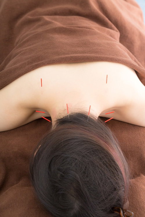 鍼治療で肩こりを解消する女性