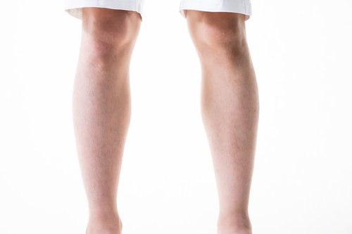 男性の足のすね毛（6mm）の毛処理前