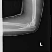 亀裂骨折した左腕のレントゲン写真の写真