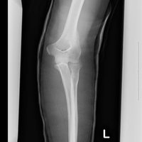 左足のレントゲン撮影、膝関節から足首までの脛骨と腓骨の写真