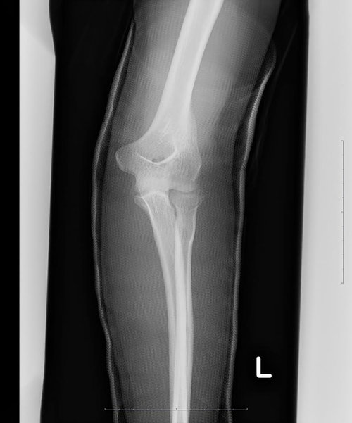 【レントゲン注意注意】左足のレントゲン撮影、膝関節から足首までの脛骨と腓骨