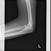 全治4週間の左腕の亀裂骨折のレントゲン写真の写真