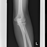 左足関節部分のレントゲンの写真