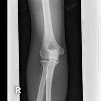 右足関節のレントゲン写真の写真