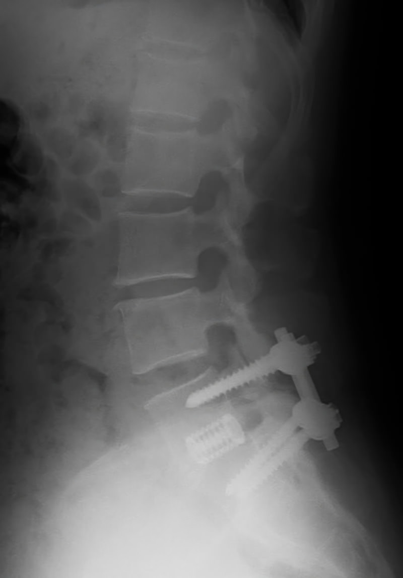 腰部脊柱管狭窄症の手術後のレントゲン画像、脊椎に金属製固定具が見える［モデル：zubotty］
