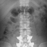 背骨に人工骨を入れ、チタン合金の固定具で固定の写真