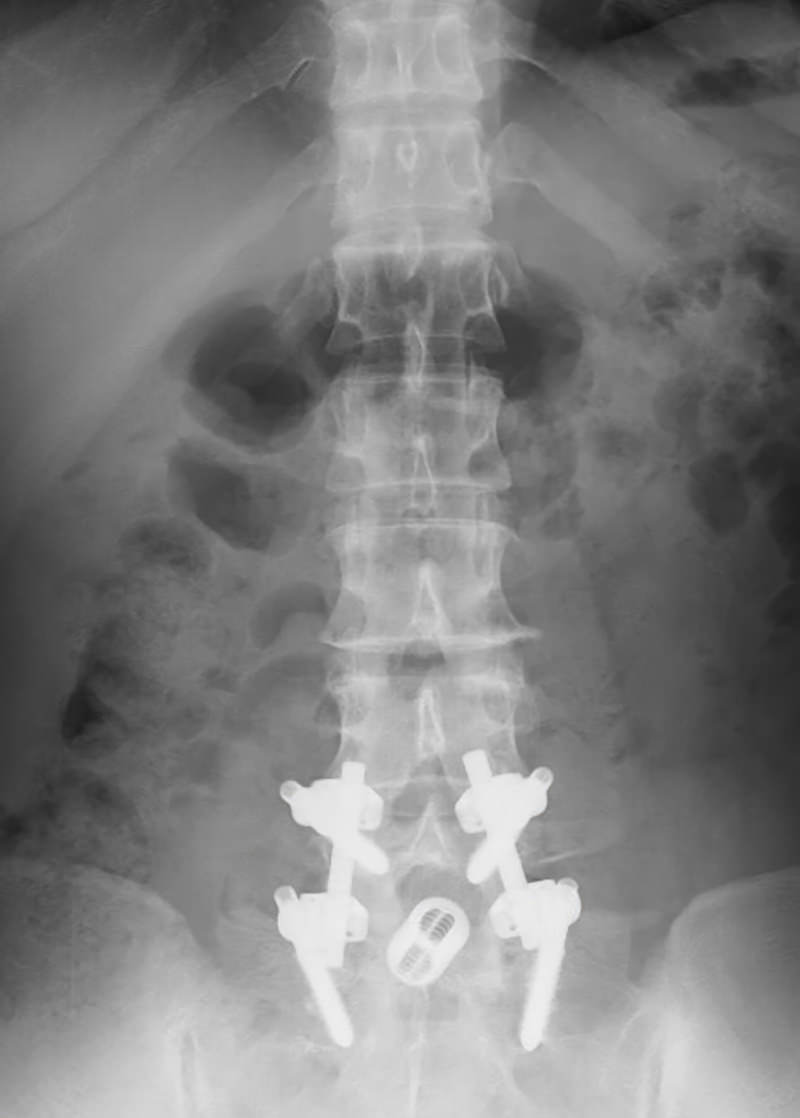 背骨にチタン合金の固定具と人工骨を埋め込んだレントゲン写真［モデル：zubotty］