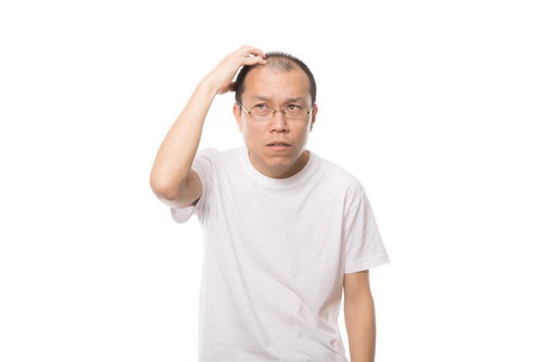 薄毛を気にして額に手を当てる男性の頭部、AGA治療や育毛の悩み