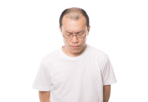 薄毛とAGAの悩みを深刻に考える眼鏡をかけた中年男性
