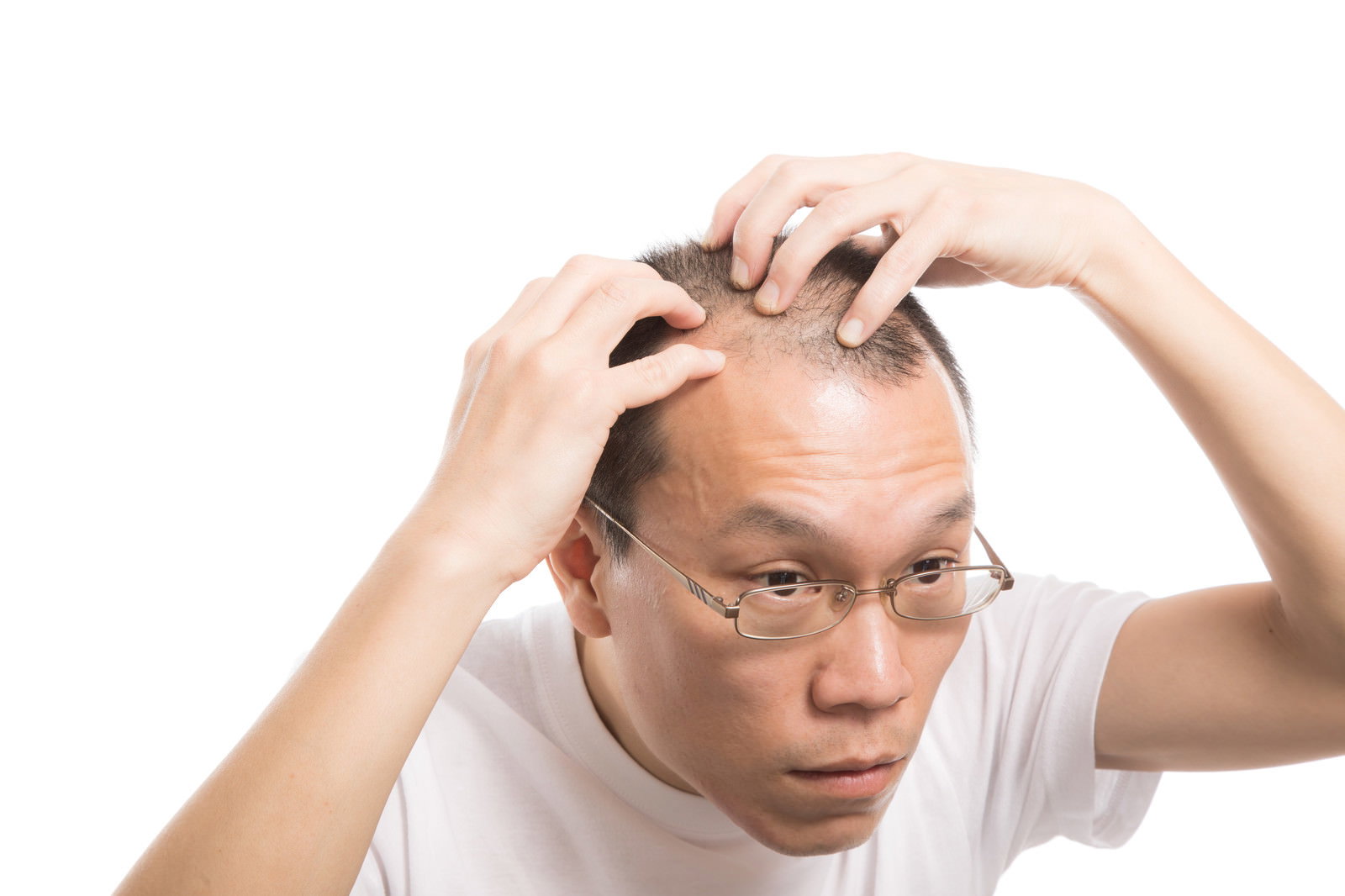 額に手を当ててM字ハゲを気にしている男性［モデル：サンライズ鈴木］