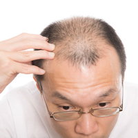 広くなったおでこ（生え際）の薄毛を気にする男性の写真