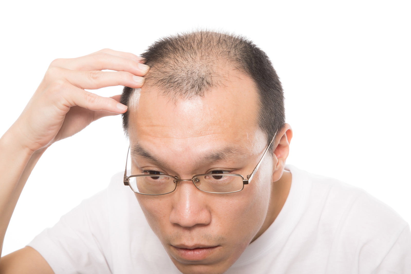 薄毛に悩み額に手を当てて困った表情をする眼鏡をかけた中年男性［モデル：サンライズ鈴木］