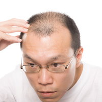 ストレスでハゲてしまった男性、額に手を当てて悩むの写真