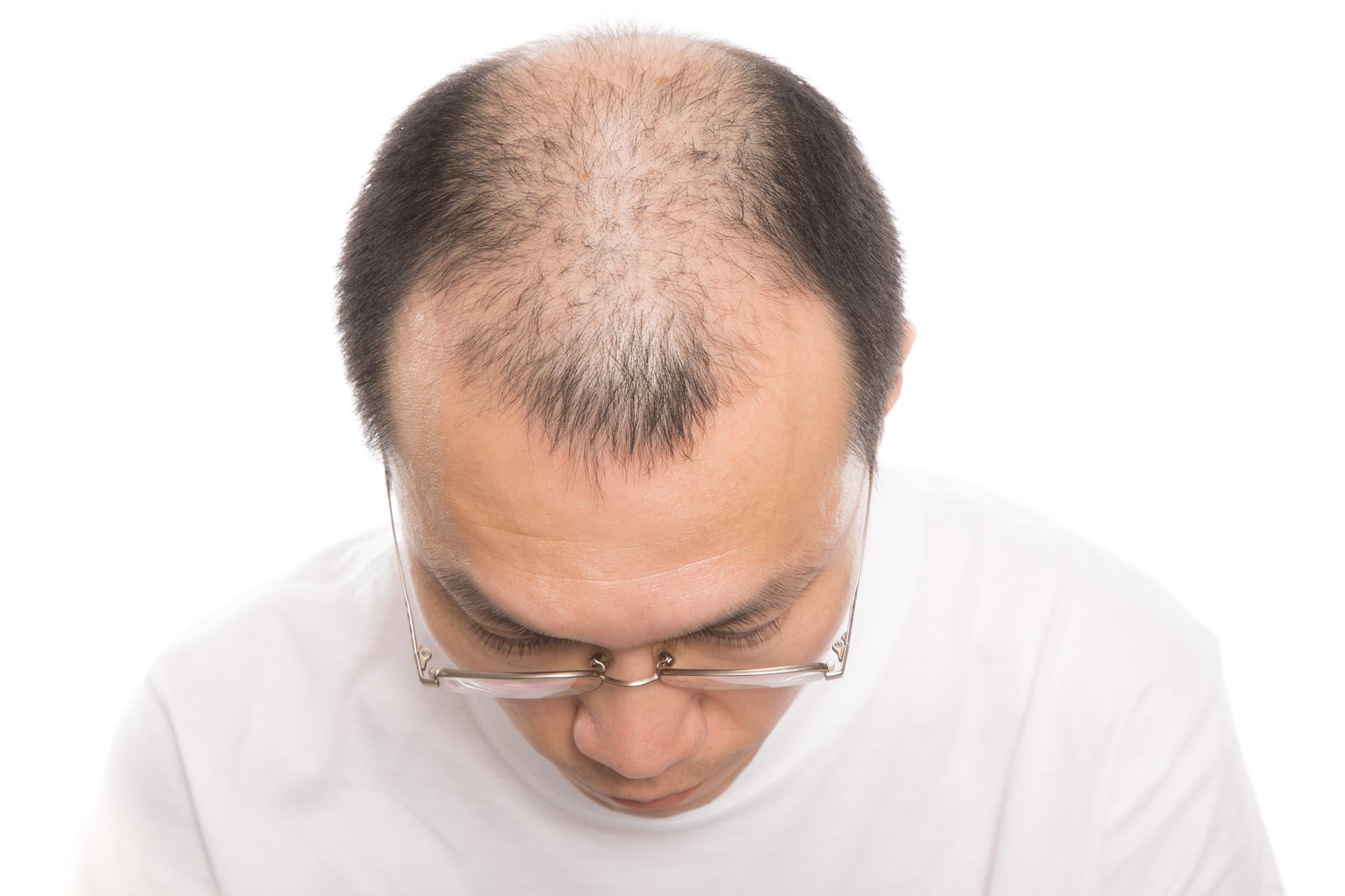前頭部と頭頂部が薄くなった眼鏡をかけた男性を上から見た様子［モデル：サンライズ鈴木］