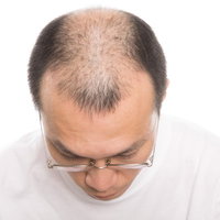 前頭部と頭頂部が薄い男性を上から撮影した頭部の俯瞰の写真