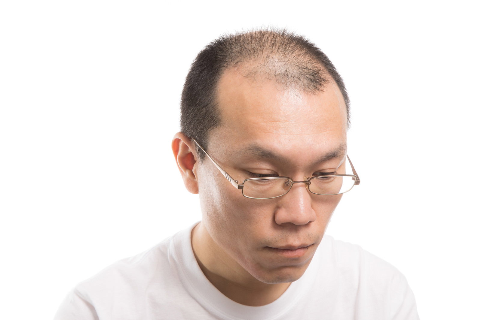 M字禿げの男性が下を向いている様子［モデル：サンライズ鈴木］