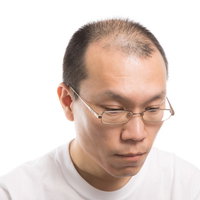 M字禿げが目立つ男性の頭頂部、生え際の後退と薄毛の状態の写真