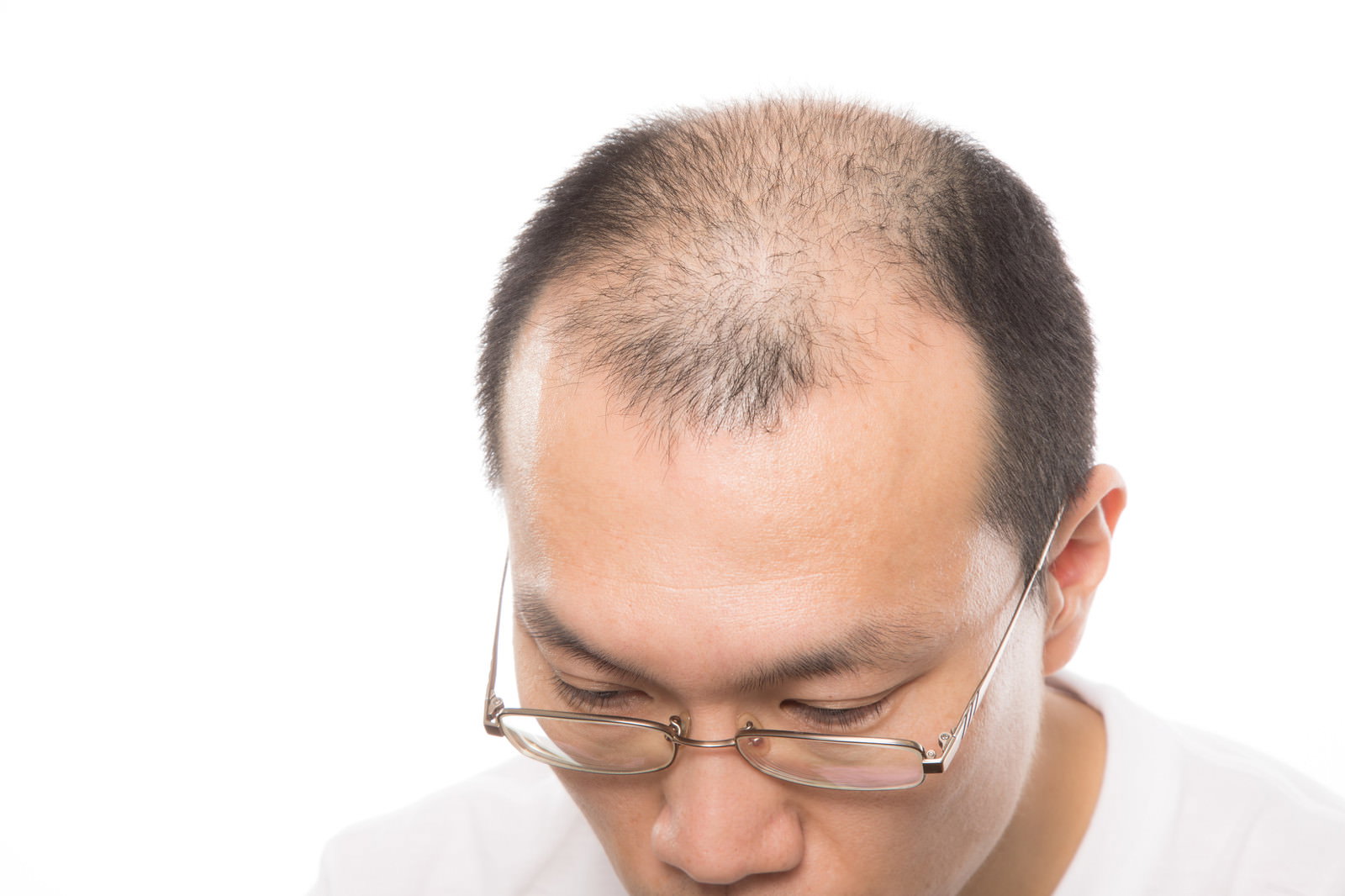 頭頂部の薄毛が目立つ中年男性［モデル：サンライズ鈴木］