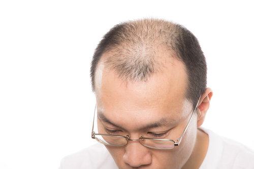 AGA（男性型脱毛症）の男性の薄毛