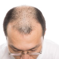 広いおでこと進行したM字ハゲの眼鏡をかけた中年男性の写真