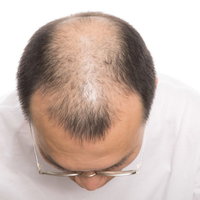 男性定番のM字ハゲと頭頂部の脱毛進行を示す医療用の写真