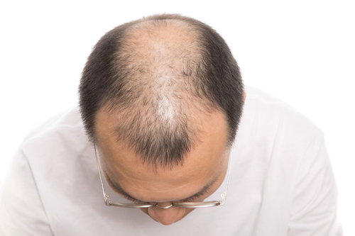 男性定番のM字ハゲと頭頂部の脱毛進行を示す医療用