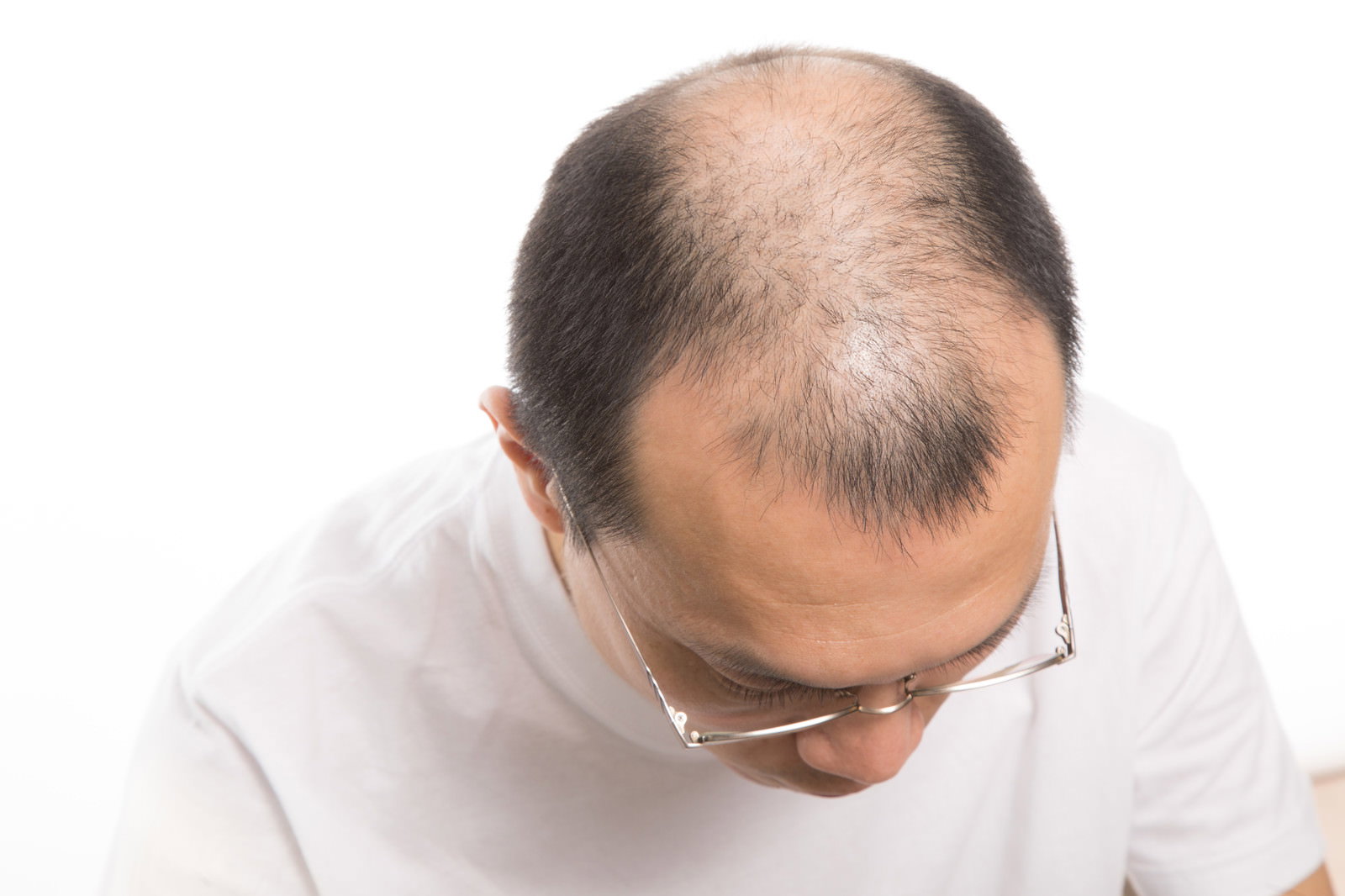 おでこの生え際から進行するM字ハゲで下を向く白いシャツの男性［モデル：サンライズ鈴木］