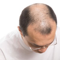 おでこの生え際から進行するM字ハゲの男性の写真