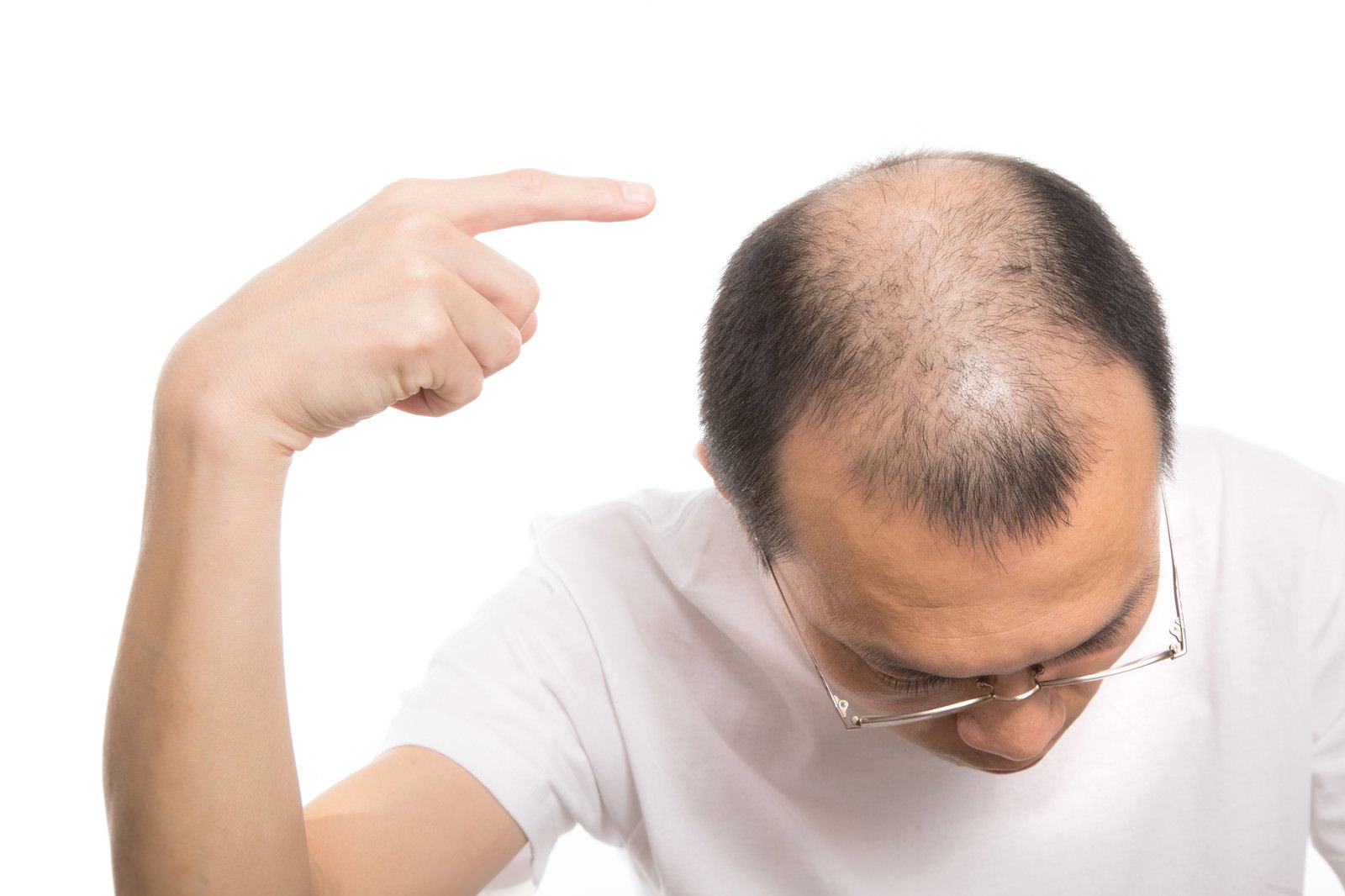 頭頂部のハゲを指差している白いTシャツの男性［モデル：サンライズ鈴木］