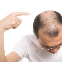 頭頂部のハゲを指差す男性の薄毛と脱毛の悩みの写真