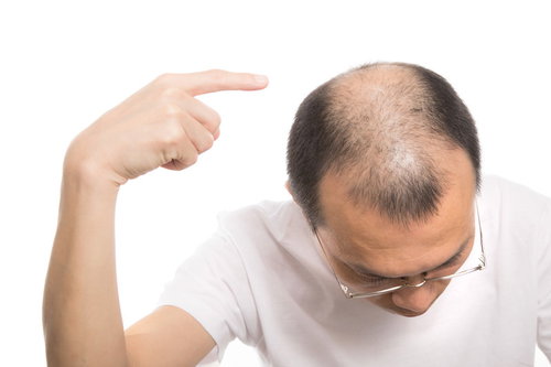頭頂部のハゲを指差す男性の薄毛と脱毛の悩み