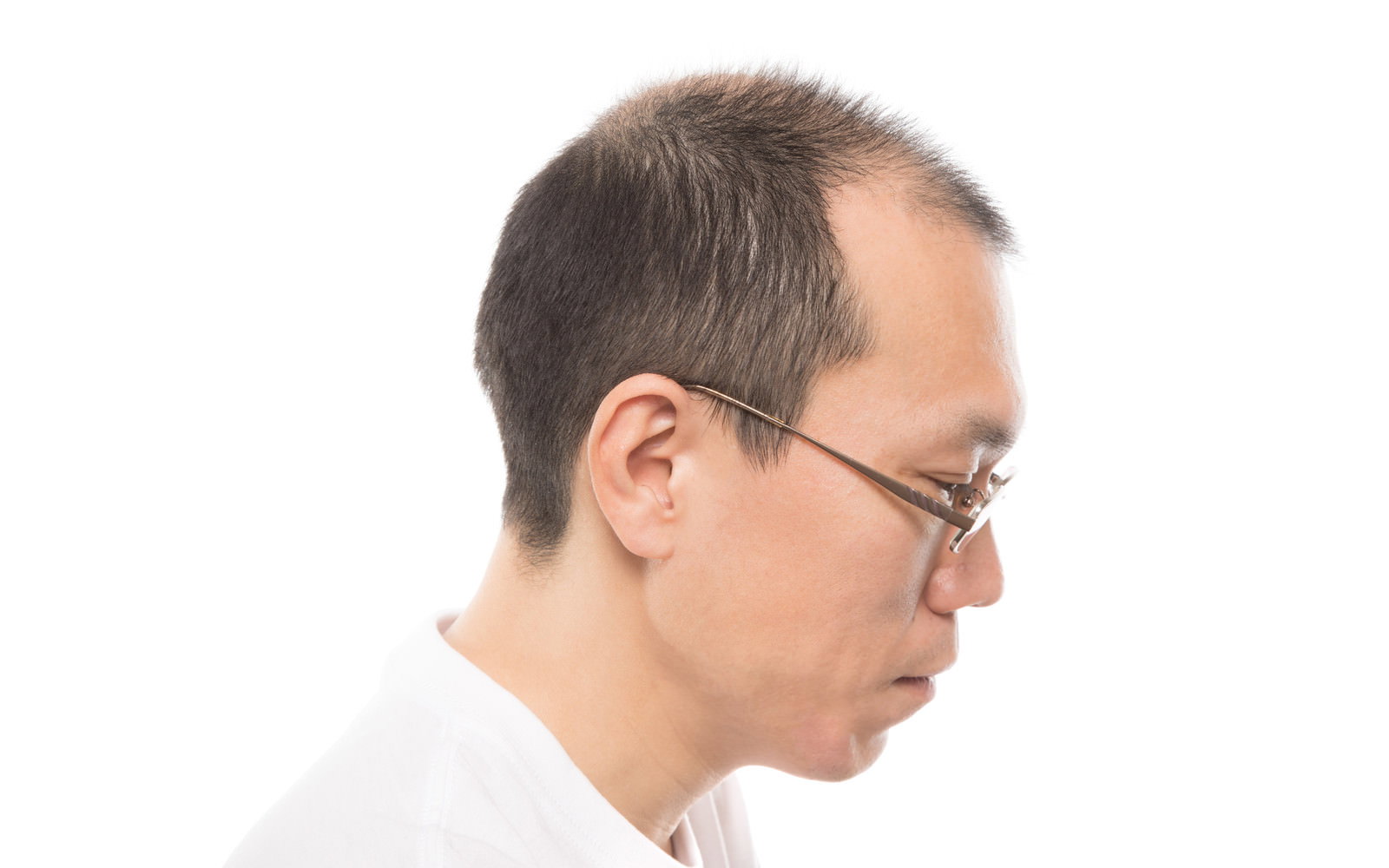 眼鏡をかけた男性の横顔、M字型に生え際が後退している様子［モデル：サンライズ鈴木］