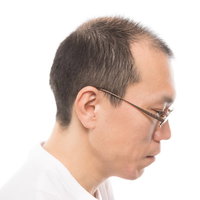 M字ハゲの男性の横顔写真、生え際後退、AGA薄毛治療の写真