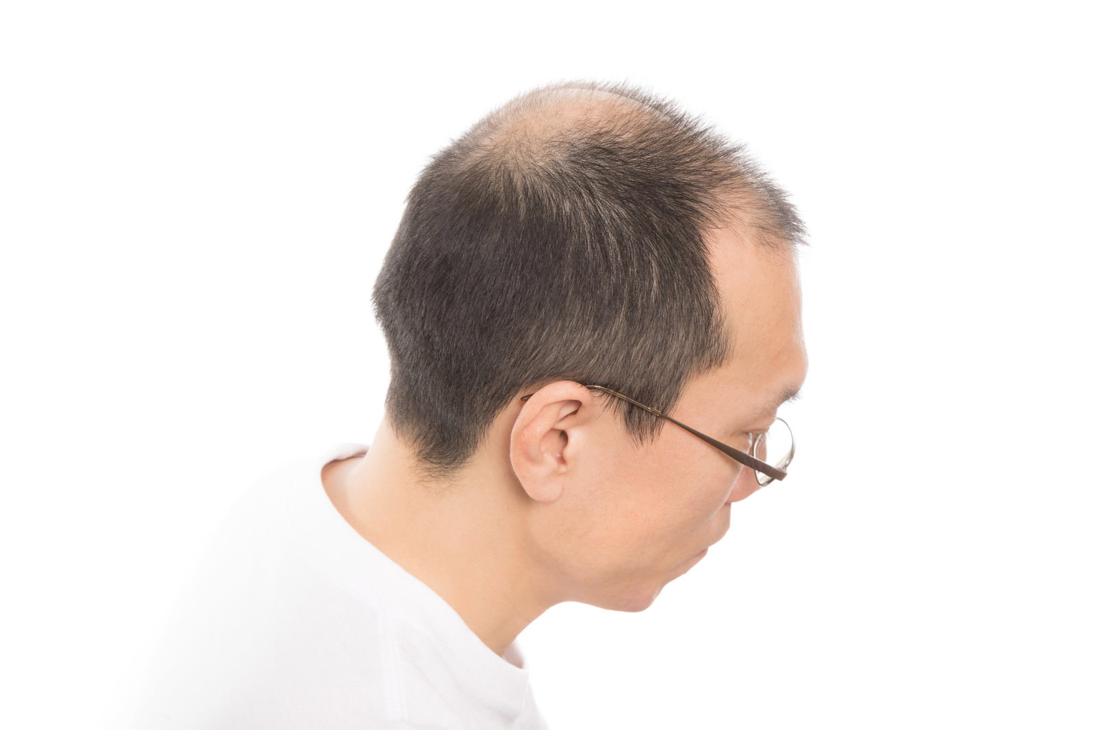 白い背景で横向きのM字ハゲと頭頂部薄毛のアラフォー男性［モデル：サンライズ鈴木］
