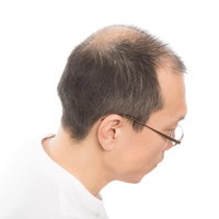 M字と頭頂部が薄いアラフォー男性の頭部の脱毛進行パターンの写真