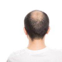 頭頂部が薄毛（男性型脱毛症・AGA）の男性の後ろ姿の写真