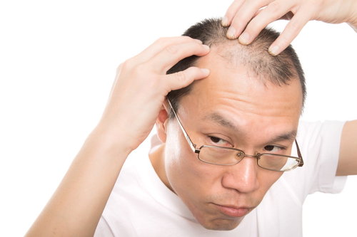 おでこが広いM字ハゲの男性が鏡で頭頂部を確認
