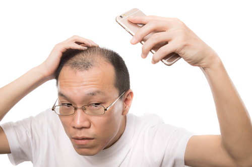 スマホの自撮りで薄毛をチェックする禿げ男性