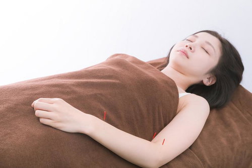 左腕に鍼を刺した美容鍼の施術、リラクゼーション効果