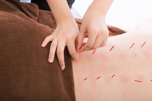 背中に鍼治療を行うリラクゼーションサロンの施術風景